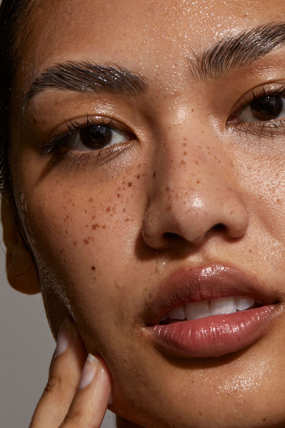 Hyperpigmentation